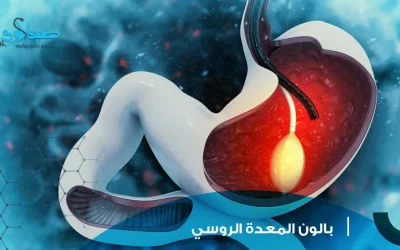 بالون المعدة الروسي