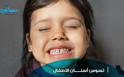 تسوس أسنان الأطفال
