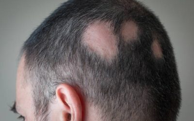 علاج الثعلبة في فروة الراس