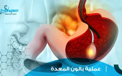 عملية بالون المعدة
